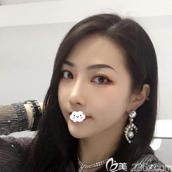 武漢美立方胡江偉割雙眼皮效果好嗎？案例術(shù)后照片