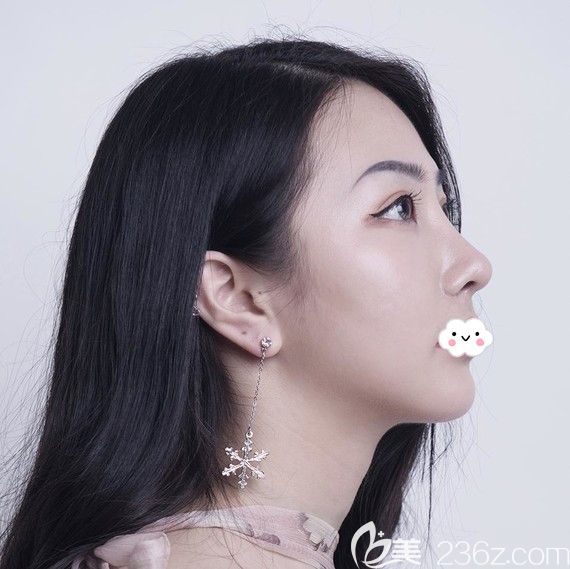 武漢美立方胡江偉隆鼻怎么樣？鼻修復(fù)案例