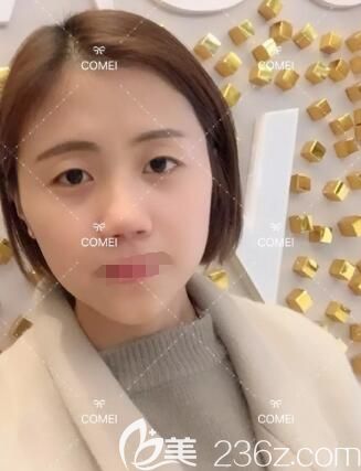 術前面診南通康美整形醫(yī)生 術前面診南通康美整形醫(yī)生