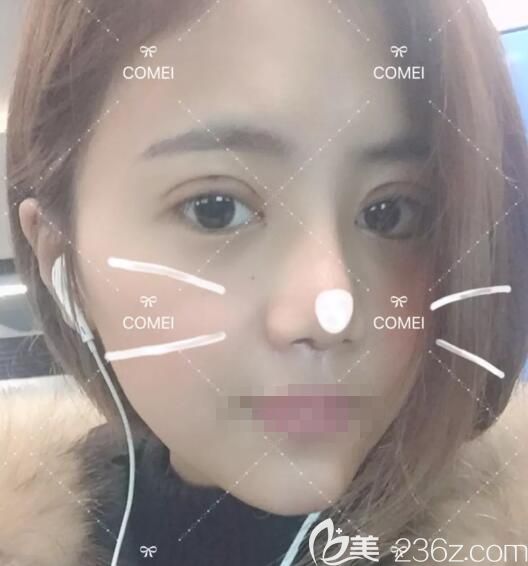 術后一周到南通康美整形醫(yī)院拆線 術后一周到南通康美整形醫(yī)院拆線