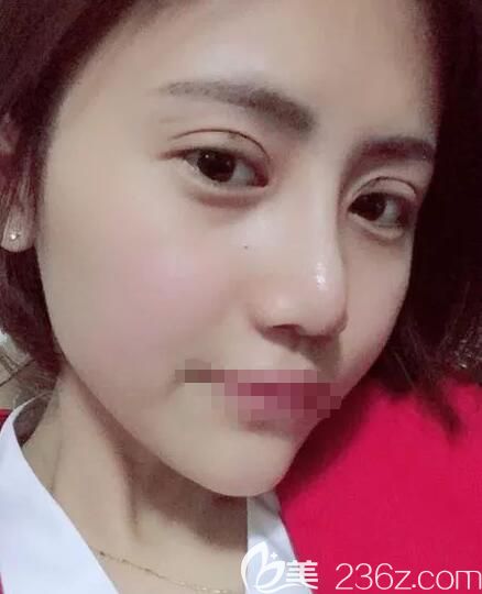 做切開雙眼皮+硅膠隆鼻+假體墊下巴術后半個月恢復 做切開雙眼皮+硅膠隆鼻+假體墊下巴術后半個月恢復