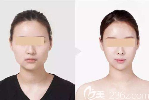 唐山蘇亞美聯(lián)臣推出2019寒假春節(jié)整形優(yōu)惠價(jià)格表 瘦臉和吸脂都只要980元