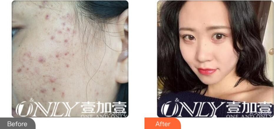 楊義祛痘祛痘印案例 楊義祛痘祛痘印案例