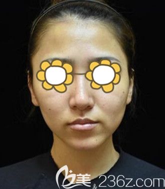 去合肥壹加壹找楊義做臉部熱提拉緊致皮膚前 去合肥壹加壹找楊義做臉部熱提拉緊致皮膚前