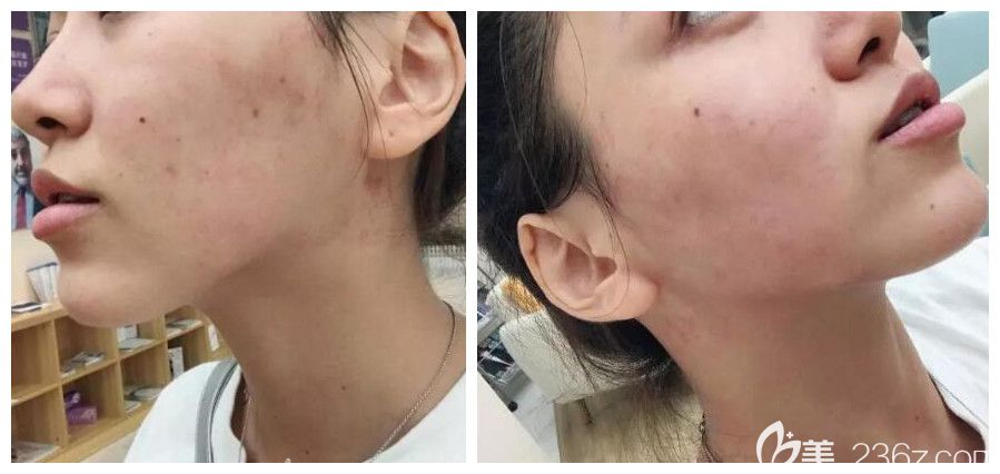 找合肥壹加壹楊義做臉部熱提拉后即刻效果圖 找合肥壹加壹楊義做臉部熱提拉后即刻效果圖