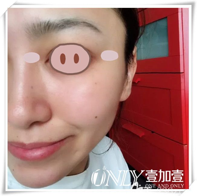 楊義面部熱提拉治療后第7天恢復(fù)情況 楊義面部熱提拉治療后第7天恢復(fù)情況