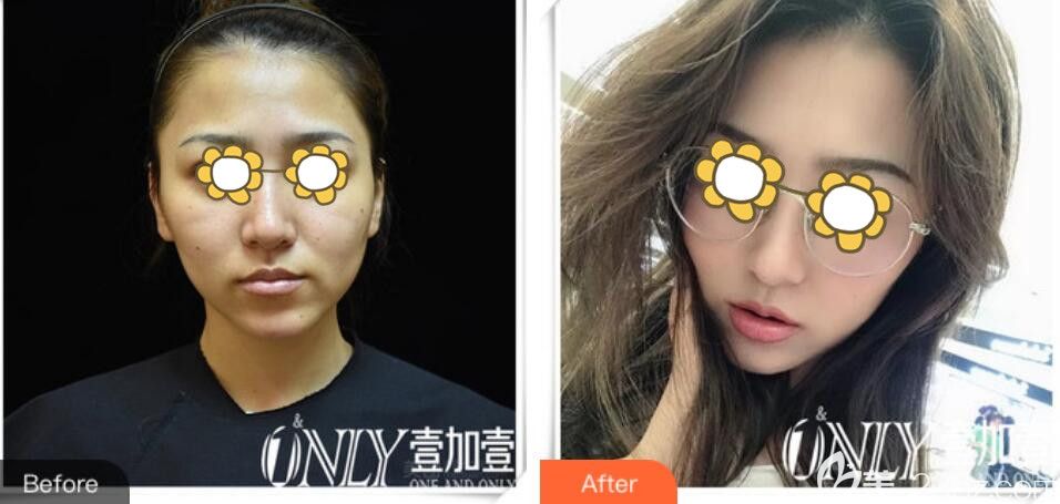 合肥壹加壹整形臉部熱提拉前后效果對比 合肥壹加壹整形臉部熱提拉前后效果對比