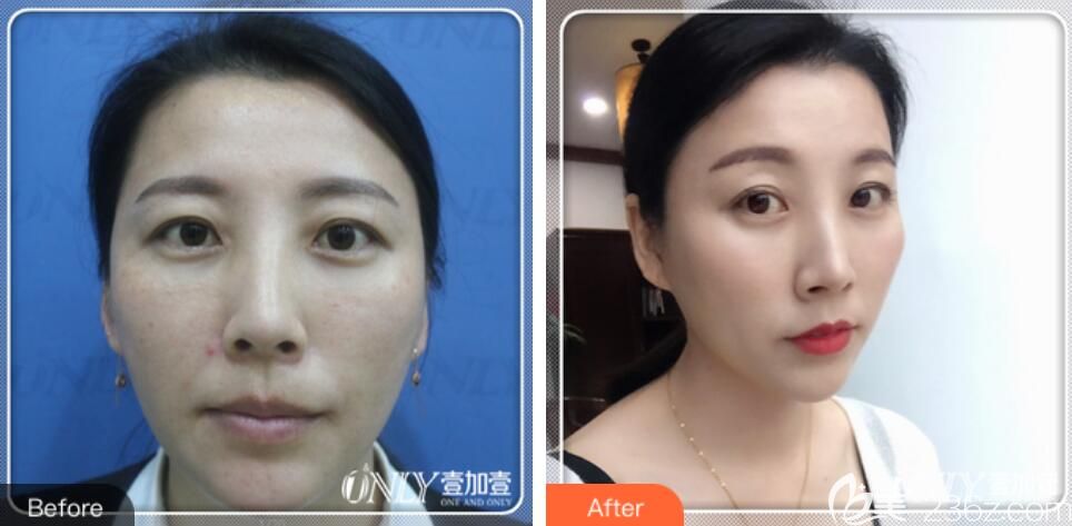 合肥壹加壹韓江穩(wěn)怎么樣？安多可黃金微針修復(fù)案例效果來證明