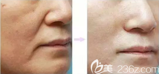 貴陽(yáng)美貝爾打玻尿酸豐效果怎么樣