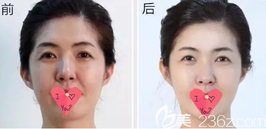 貴陽(yáng)美貝爾玻尿酸面部填充前后效果