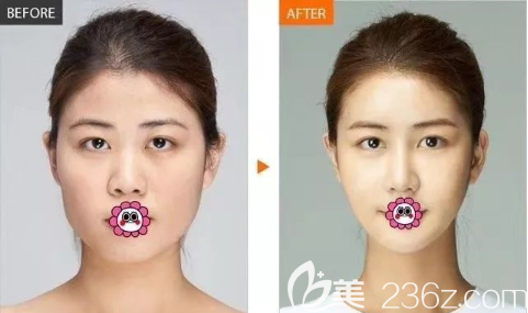 貴陽(yáng)美貝爾玻尿酸加瘦臉效果對(duì)比