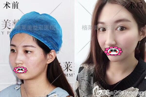 福州格萊美雙眼皮對比圖