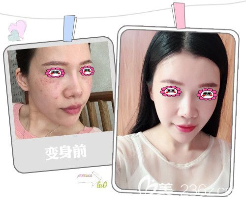 福州格萊美祛斑效果圖