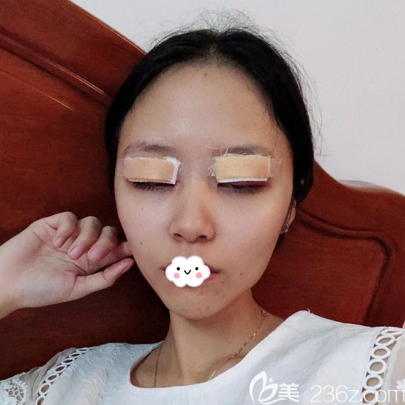 <!--<i data=20240703-sp></i>-->時光割雙眼皮效果怎么樣？包濤眼綜合案例