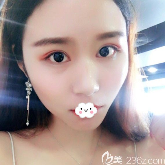 <!--<i data=20240703-sp></i>-->時光包濤雙眼皮+開內(nèi)眼角案例術(shù)后效果