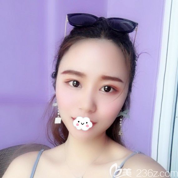 武漢雙眼皮哪家醫(yī)院好？<!--<i data=20240703-sp></i>-->包濤眼綜合案例