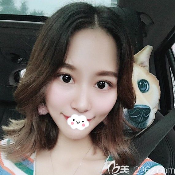 時光整形醫(yī)院割雙眼皮效果好嗎?找包濤做眼綜合術后2月怡然成為美麗公舉