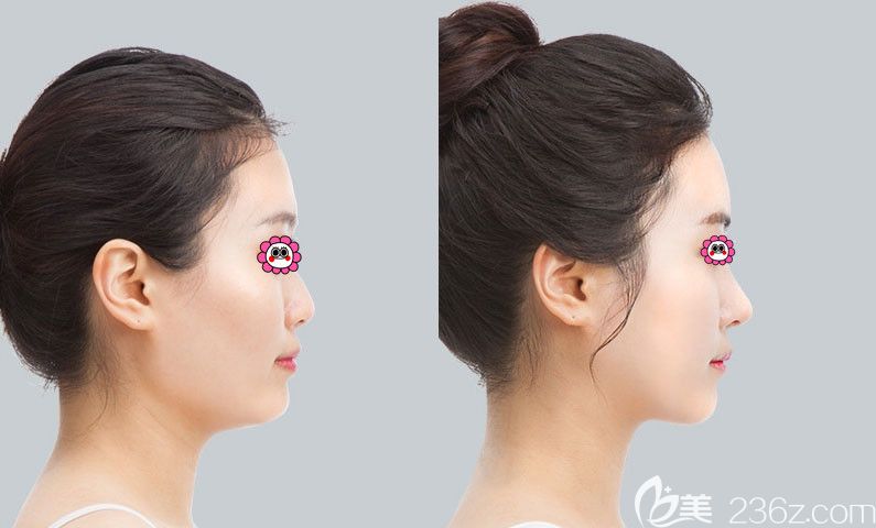 太原華美隆鼻對比圖