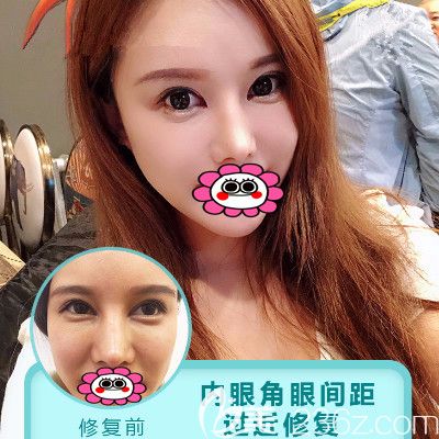 于智宏雙眼皮失敗修復效果圖