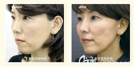 木村幸志伊做蛋白線提拉半側(cè)面前后對(duì)比 木村幸志伊做蛋白線提拉半側(cè)面前后對(duì)比