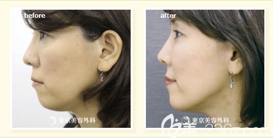 木村幸志伊做蛋白線提拉側(cè)面前后對(duì)比 木村幸志伊做蛋白線提拉側(cè)面前后對(duì)比