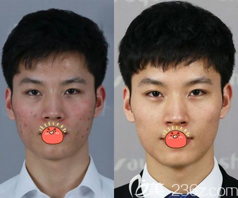 永康光大劉瑞O4元素破繭療法祛痘案例