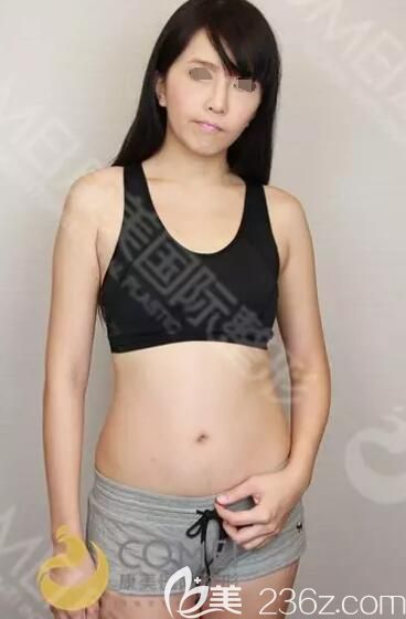 面診南通康美術(shù)前胸部較小 面診南通康美術(shù)前胸部較小