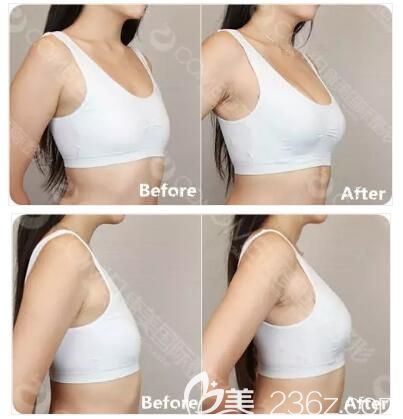 術(shù)后一周南通康美分享術(shù)前術(shù)后豐胸對比 術(shù)后一周南通康美分享術(shù)前術(shù)后豐胸對比