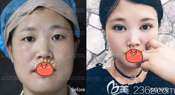 在永康光大做雙眼皮開(kāi)眼角對(duì)比圖