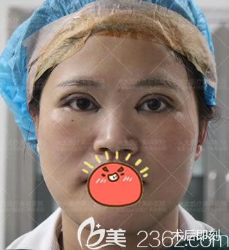 永康光大醫(yī)院剛做完雙眼皮照片
