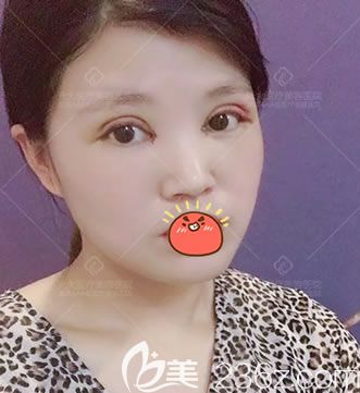 在永康光大做雙眼皮開(kāi)眼角3天后