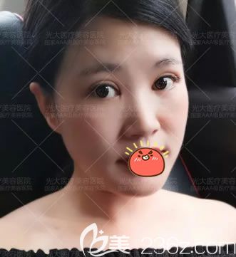 做完雙眼皮開(kāi)眼角15天恢復(fù)照