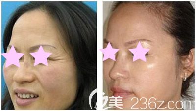 玉林時光整形李紅梅醫(yī)生面部除皺案例