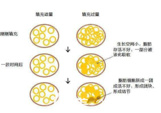 自體脂肪結節(jié)和液化的示意圖