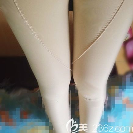 我在南寧華美做大腿吸脂術(shù)后第3天的照片 我在南寧華美做大腿吸脂術(shù)后第3天的照片