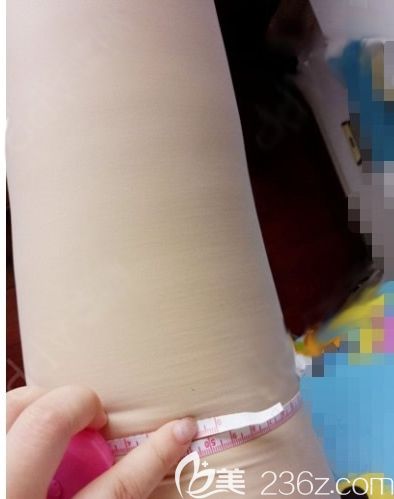 我在南寧華美整形做吸脂后第7天照片 我在南寧華美整形做吸脂后第7天照片