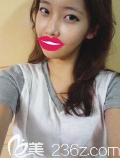 劉云濤院長(zhǎng)做假體隆胸前胸部平坦 劉云濤院長(zhǎng)做假體隆胸前胸部平坦