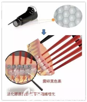 祛斑和修復(fù)同步進(jìn)行