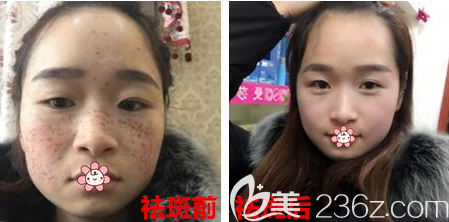 重慶藝星整形皮秒祛雀斑案例