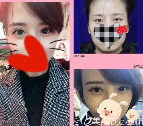 楊明鋒醫(yī)生雙眼皮前后對比圖