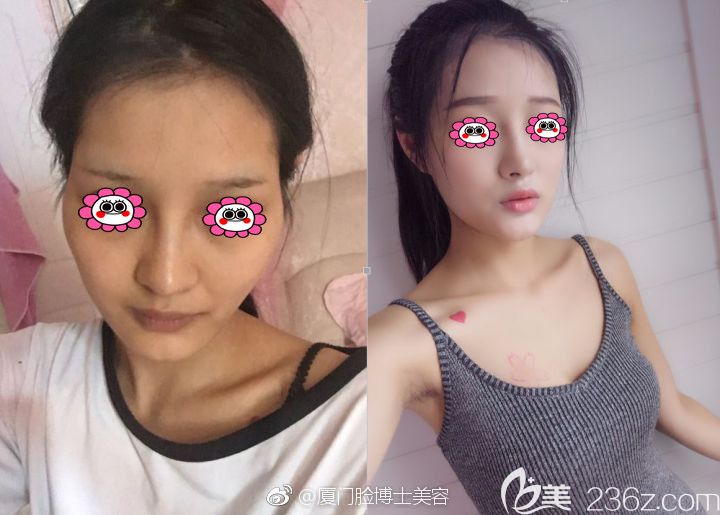 廈門臉博士醫(yī)生唐毅面部脂肪填充對比圖