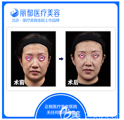 北京米蘭柏羽麗都高艷瘦臉除皺瘦臉案例 北京米蘭柏羽麗都高艷瘦臉除皺瘦臉案例