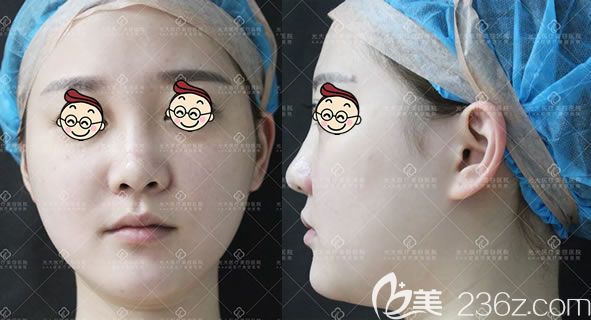 在永康光大醫(yī)院做鼻子之前 在永康光大醫(yī)院做鼻子之前