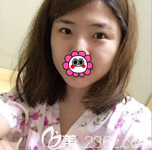 在北京畫(huà)美做雙眼皮修復(fù)前樣子 在北京畫(huà)美做雙眼皮修復(fù)前樣子