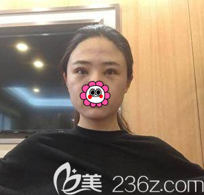 在北京畫(huà)美做雙眼皮修復(fù)第4天<span style= 在北京畫(huà)美做雙眼皮修復(fù)第4天<span style=