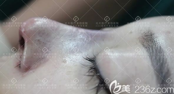在永康光大整形做完鼻子即刻效果 在永康光大整形做完鼻子即刻效果