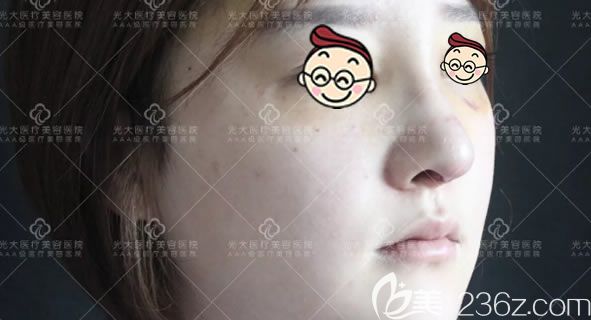 做完鼻綜合隆鼻7天恢復(fù)照 做完鼻綜合隆鼻7天恢復(fù)照