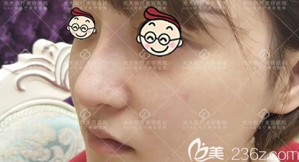 做完膨體和軟骨鼻綜合30天后 做完膨體和軟骨鼻綜合30天后