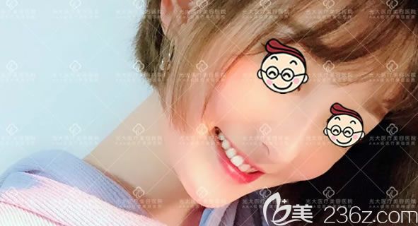 好嗨喲,2018年7月29日在永康光大整形做了鼻綜合隆鼻和V臉術(shù)后感覺人生已經(jīng)到達(dá)了巔峰