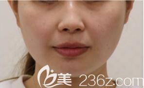 高澤博和面部吸脂前正面 高澤博和面部吸脂前正面